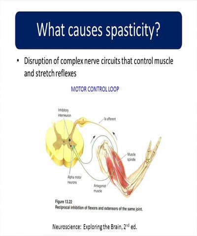 Spinal cord injury spasticity