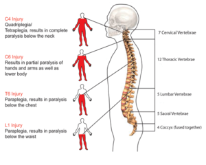 Spinal cord injury types and causes